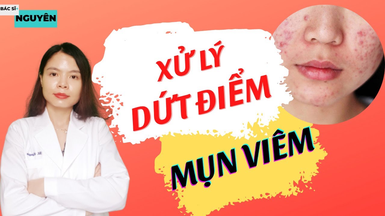 05 Lưu ý trị mụn viêm sưng đỏ - mụn viêm mủ tại nhà