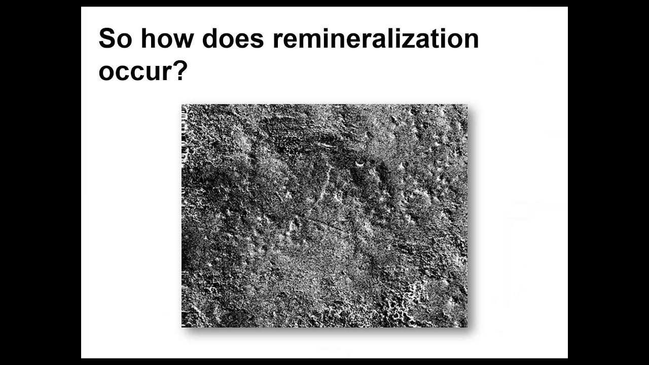 Remineralization- Why Fluoride Isn't Enough