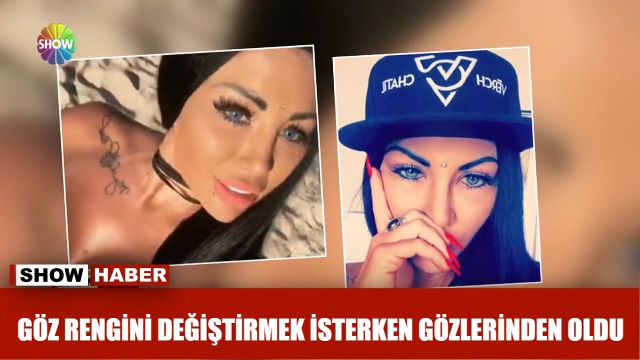 Göz rengini değiştirmek isterken gözlerinden oldu