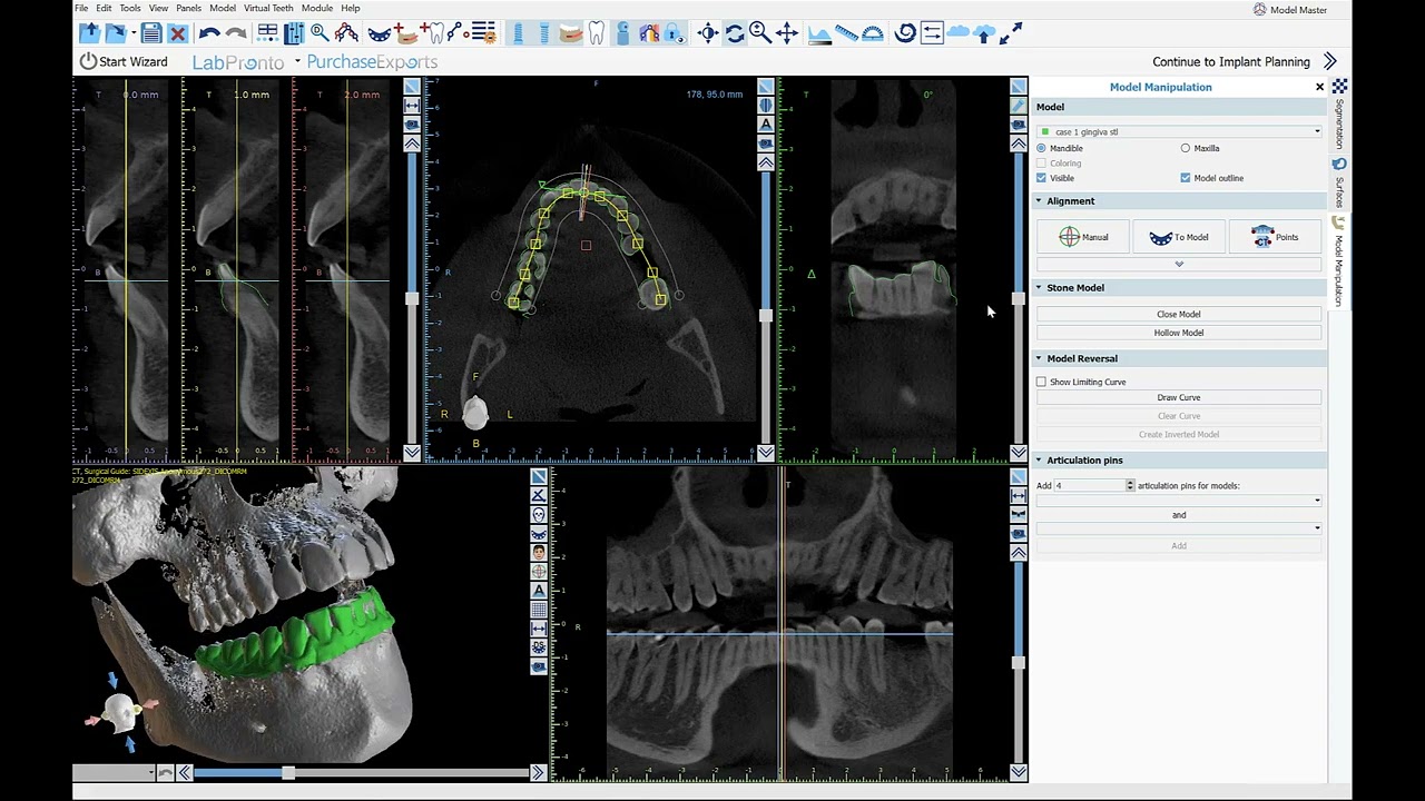 BSP4.11: Completely Automatic CT Tooth Segmentation