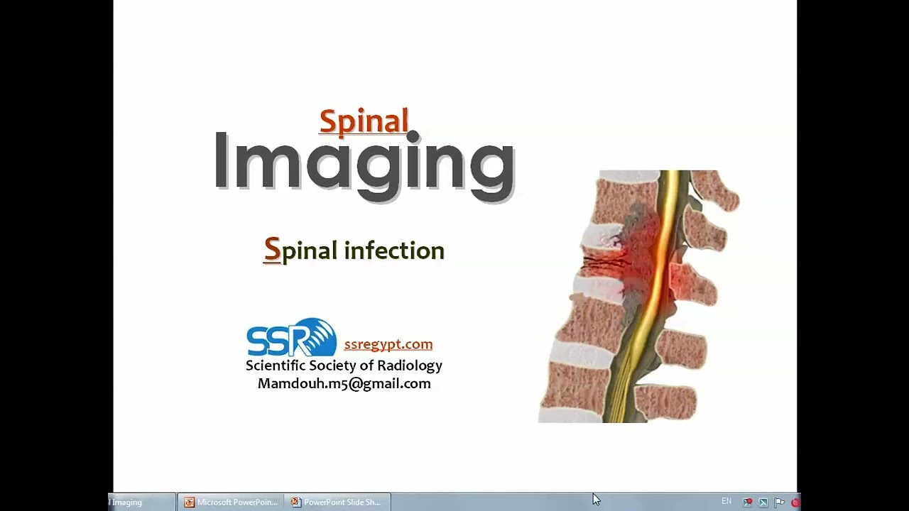 Spinal imaging Infection & inflammation (DRE) Prof. Mamdouh Mahfouz