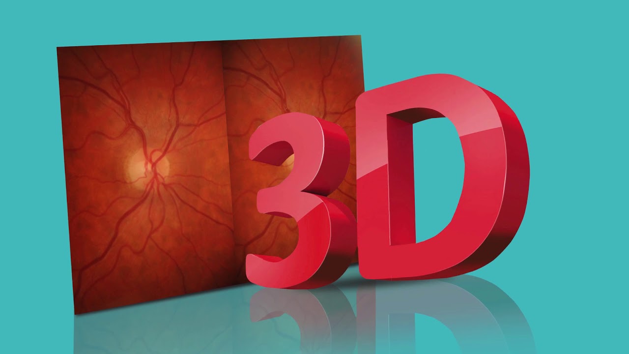 Kowa Nonmyd WX-3D Simultaneous Stereoscopic Retinal Camera