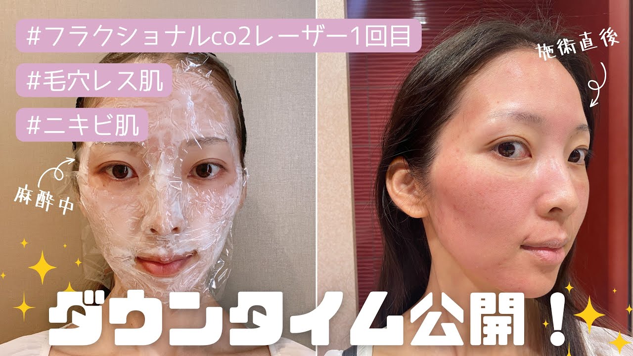 【毛穴/美容医療】ニキビ肌女がフラクショナルCO2レーザー１回目打ってきた！ダウンタイムの様子と効果を報告