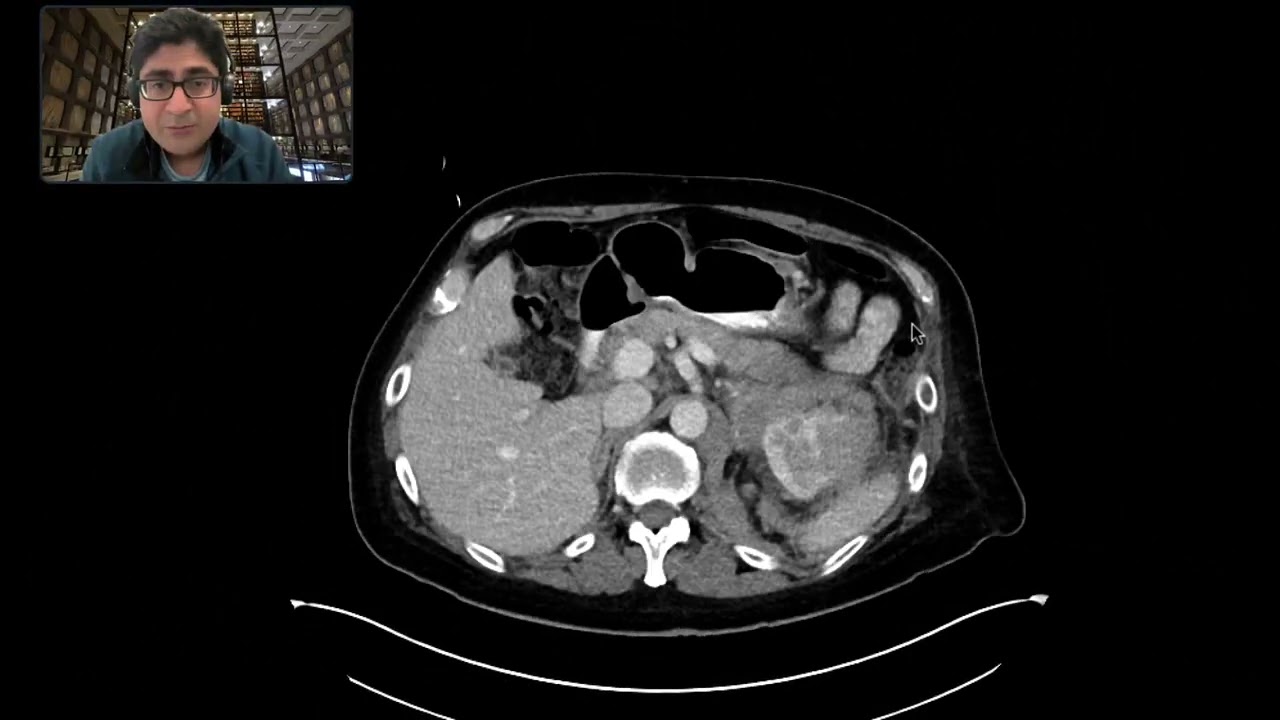 Lymphoma