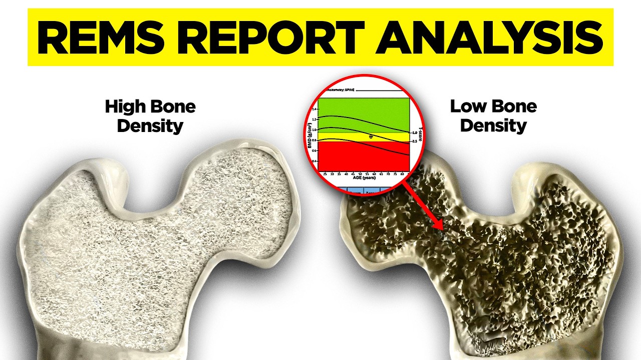 My Bone Transformation Story: Orthopedic Surgeon Reviews His REMS Report