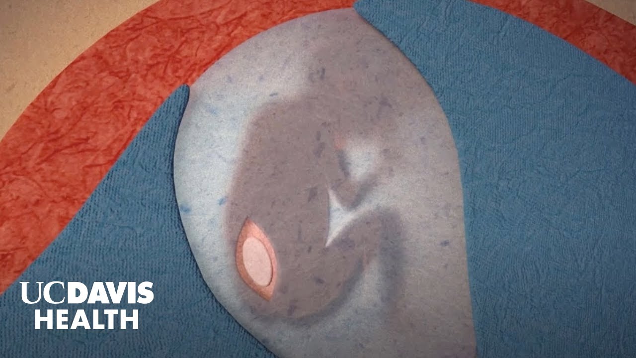 Fetal Surgery for Spina Bifida (Myelomeningocele) - UC Davis Children's Hospital