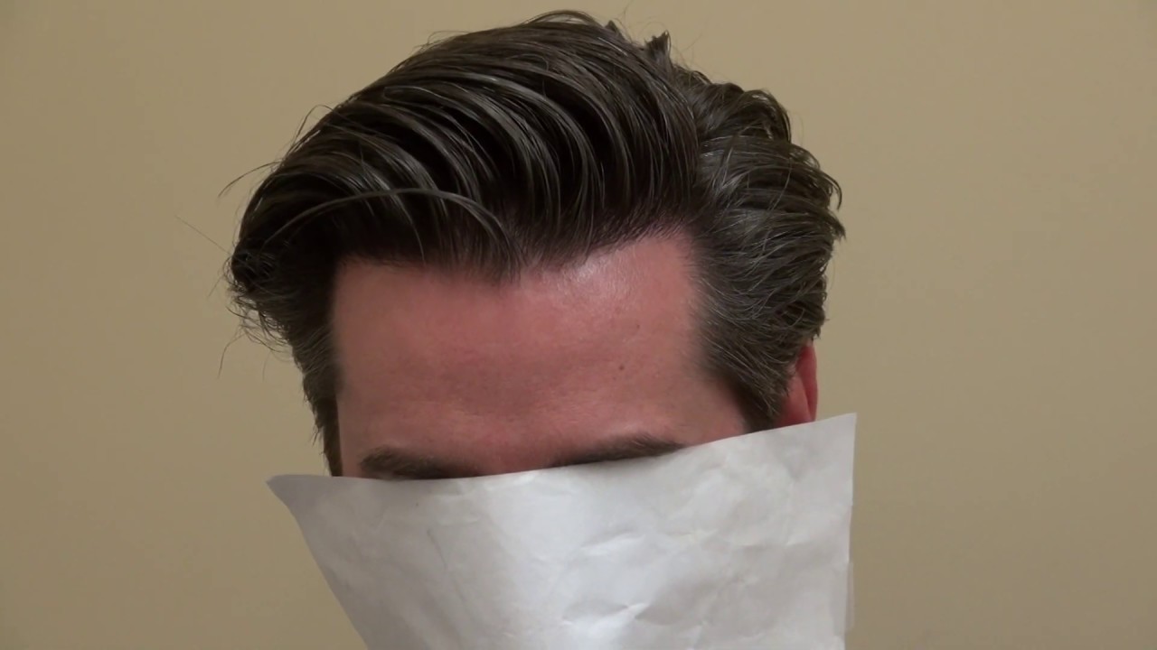 FUE Hair Transplant Surgery Extreme Dense Post Op Results  Dr. Diep at http://www.mhtaclinic.com