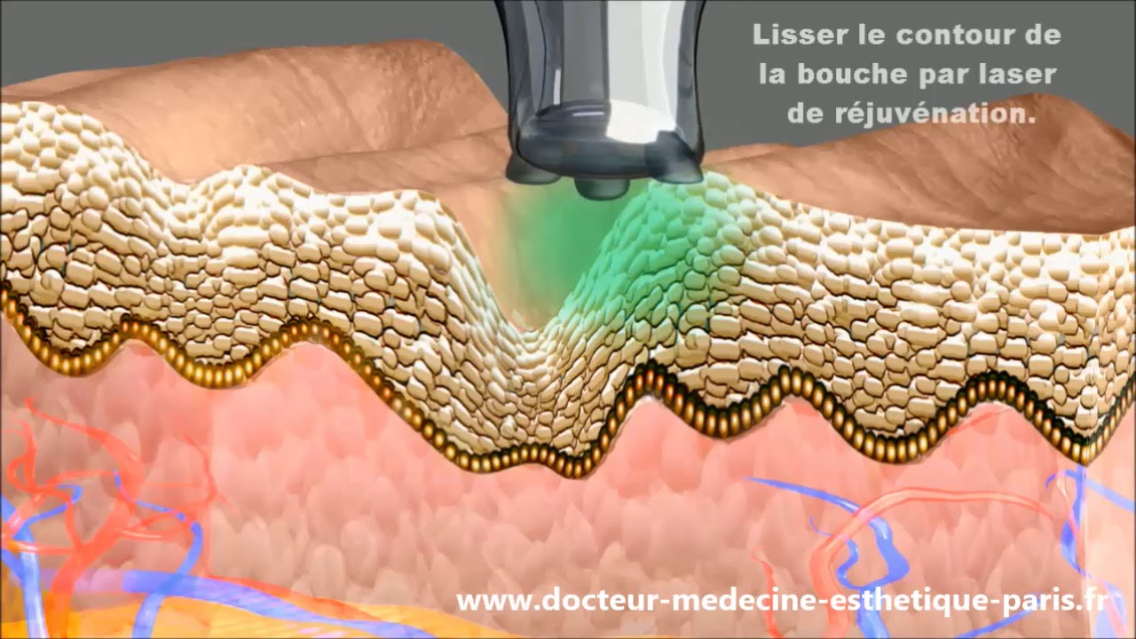 Le traitement au laser fractionné à Paris -  Dr Cheriet