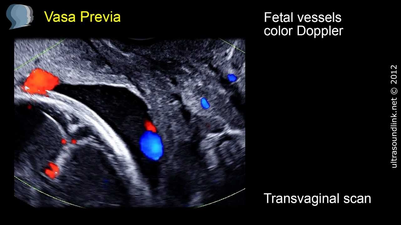 Vasa Previa - ultrasound diagnosis
