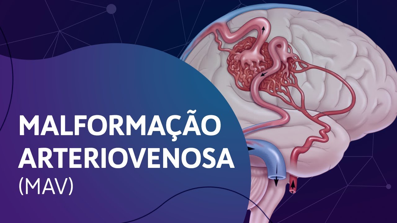 Malforma&ccedil;&atilde;o Arteriovenosa