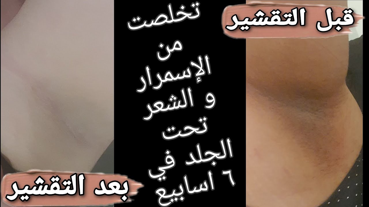 الحقيقة عن التقشير البارد truth behind peels