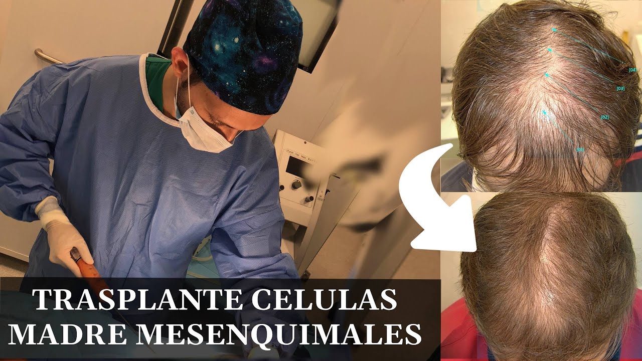 Trasplante de células madre mesenquimales para tratar la alopecia.