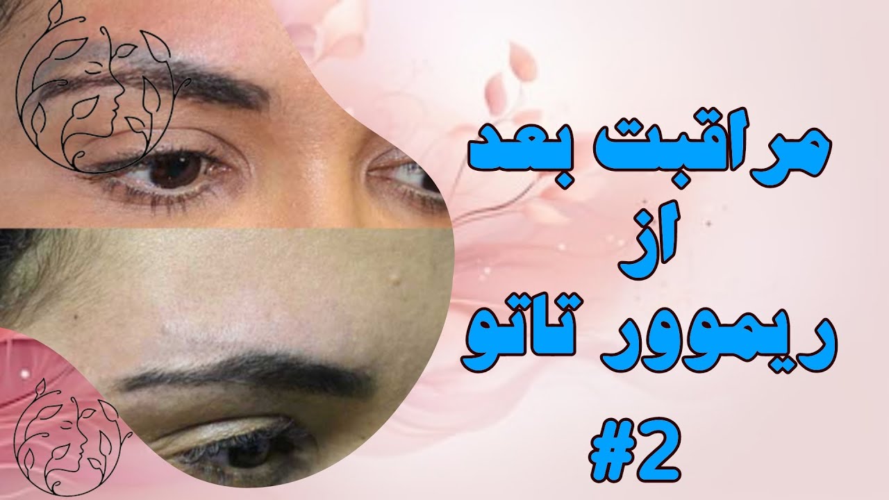 آموزش مراقبت بعد از ریموور تاتو | مراقبت بعد از تمام ریموورهای تاتو | بعد از ریموور تاتو چکار کنم