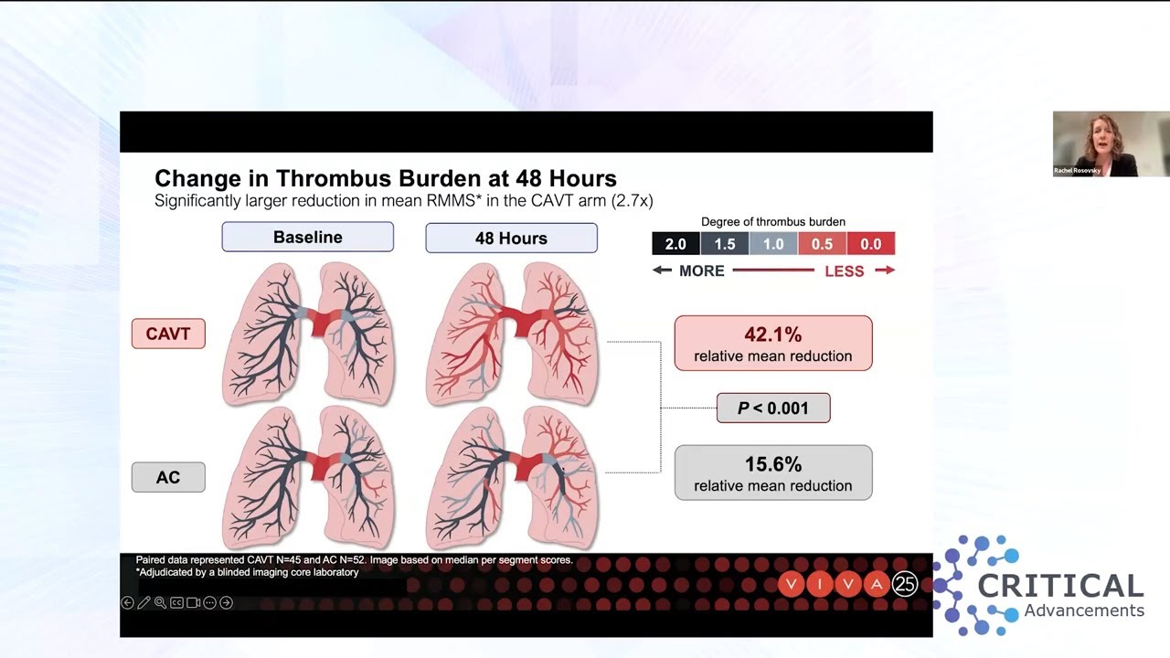 Critical Advancements: Evolving Data and Technology for Advanced Treatment of Pulmonary Embolism