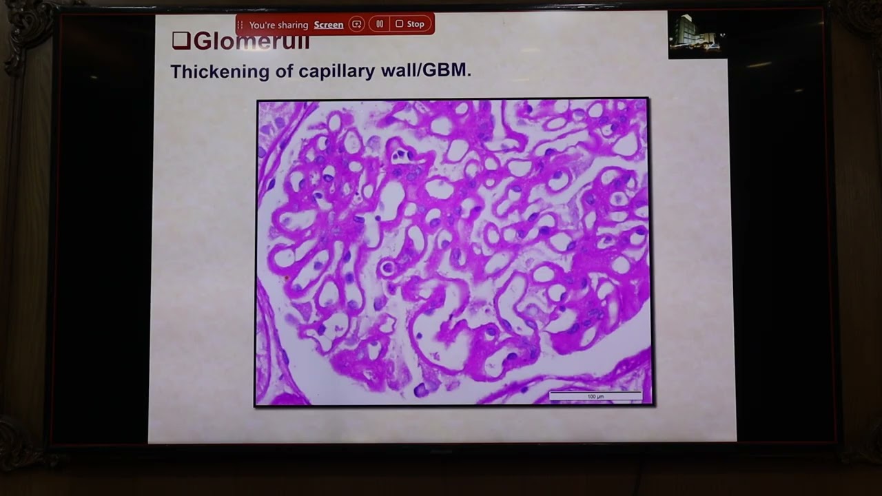 INTERPRETATION OF NEPHROPATHOLOGY REPORT- DR.Mona Abdelrahim, MD, PhD