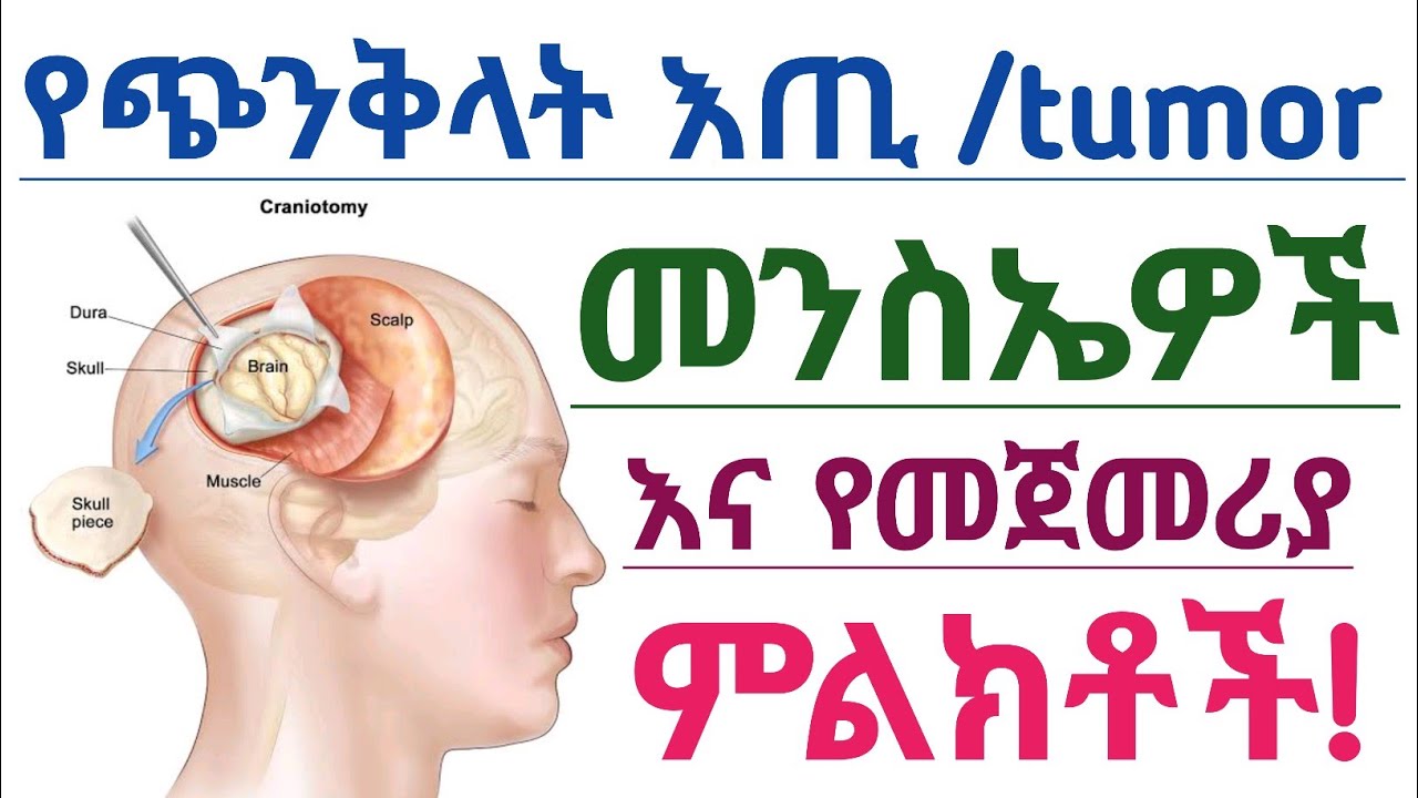 የጭንቅላት እጢ ምንነት፣ ምልክቶችና አጋላጭ ሁኔታዎች| Brain tumor causes and  symptoms
