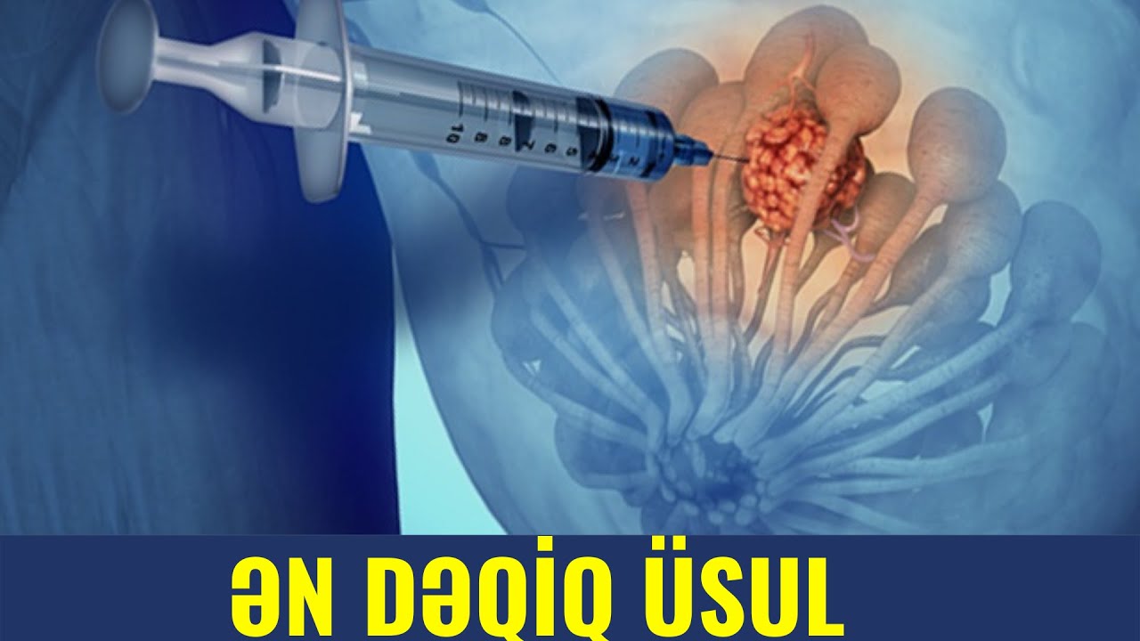 Döş Xərçəngi ƏN DƏQİQ BELƏ Bilinir! - Tru Cut Biopsiyası