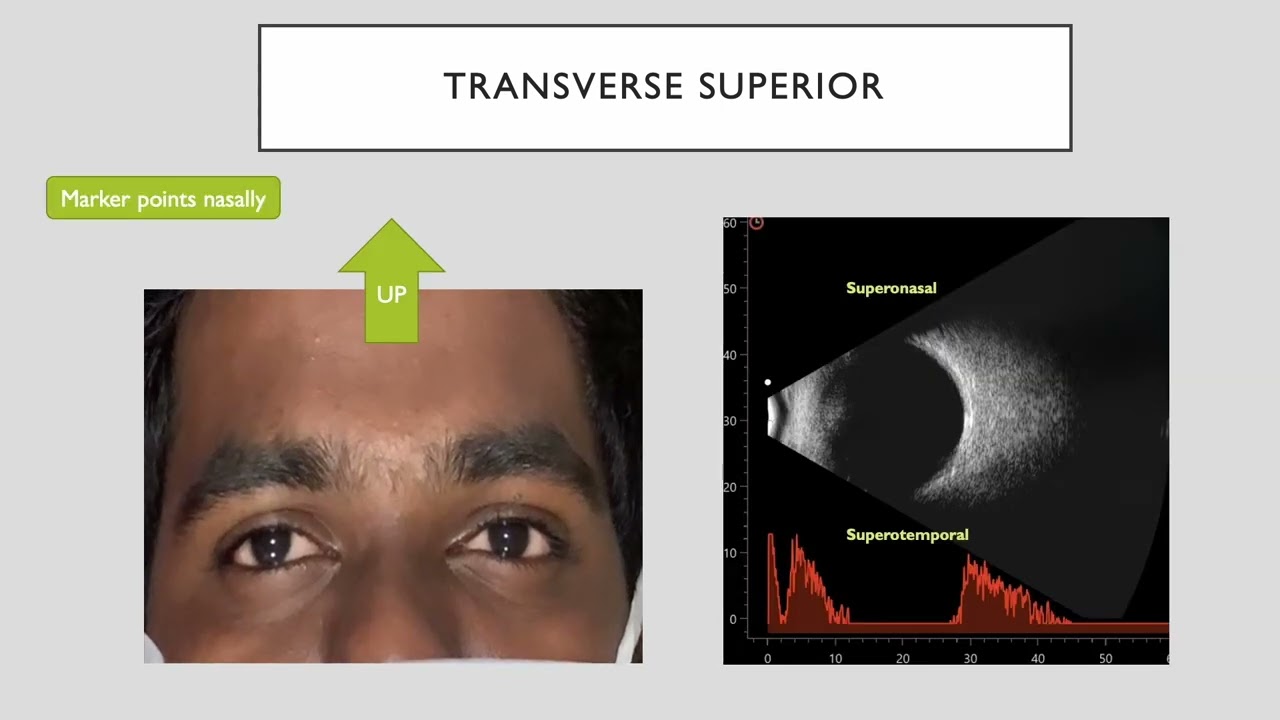 Ten tips to master ultrasound B‑scanof the posterior segment of the eye