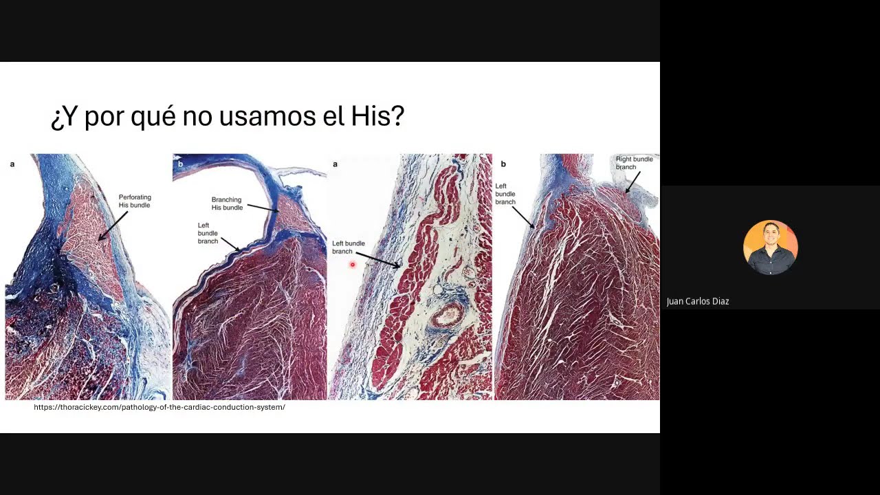 Estimulación de rama izquierda - Dr Juan Carlos Díaz