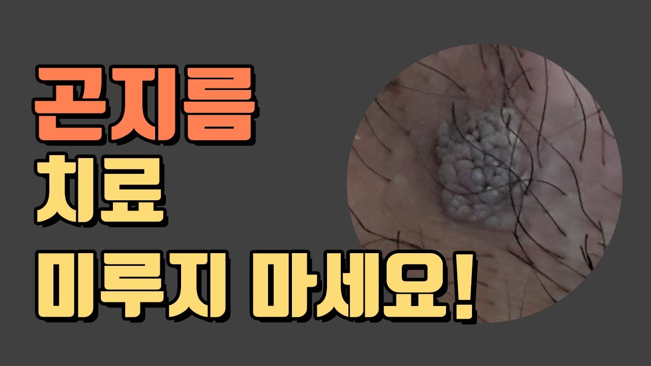 곤지름(condyloma 콘딜로마) = 성기사마귀 치료 미루지 마세요!