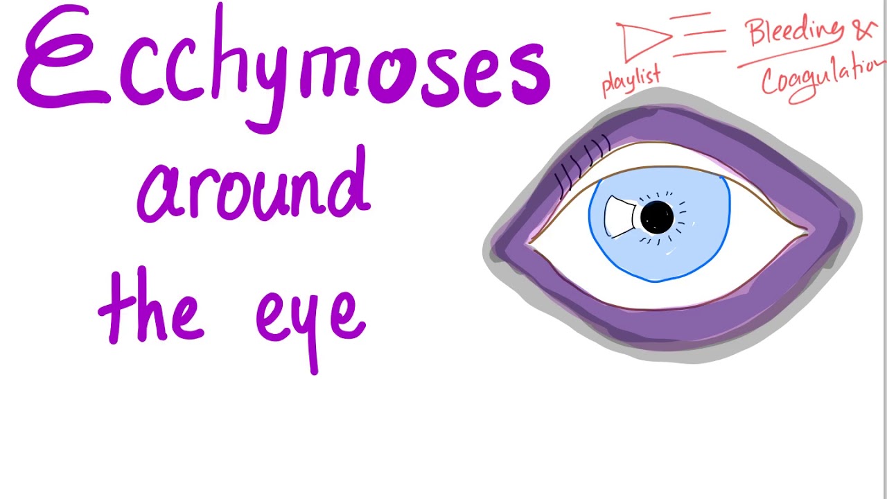 Ecchymoses around the eye