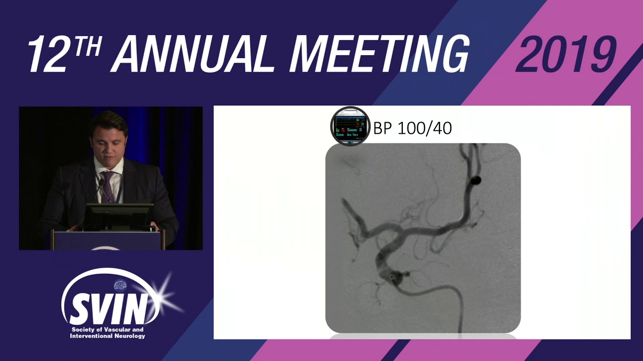 SVIN 2019: Flow Diversion in Ruptured Aneurysms and Distal Aneurysms: When and How I do It