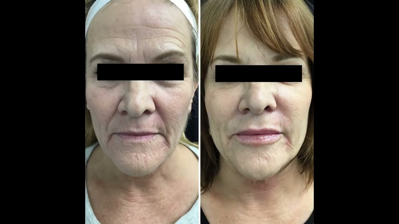 Collagen Biostimulants Injectables like Radiesse and Sculptra Are The Future