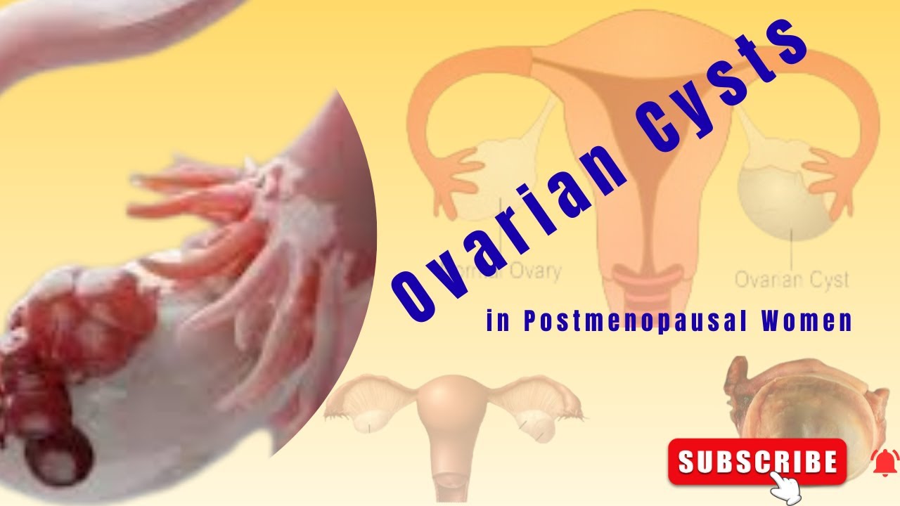 The Management of Ovarian Cysts in Postmenopausal Women / GTG / RCOG Guideline