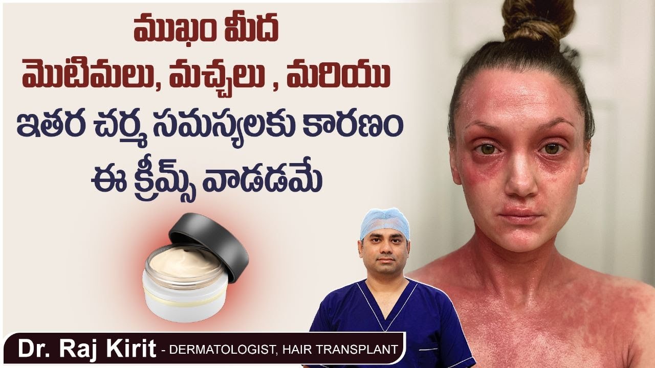 స్టెరాయిడ్ క్రీమ్‌లు వాడుతున్నారా? | Intresting Facts About Steroid Creams In Telugu | Dr Raj Kirit