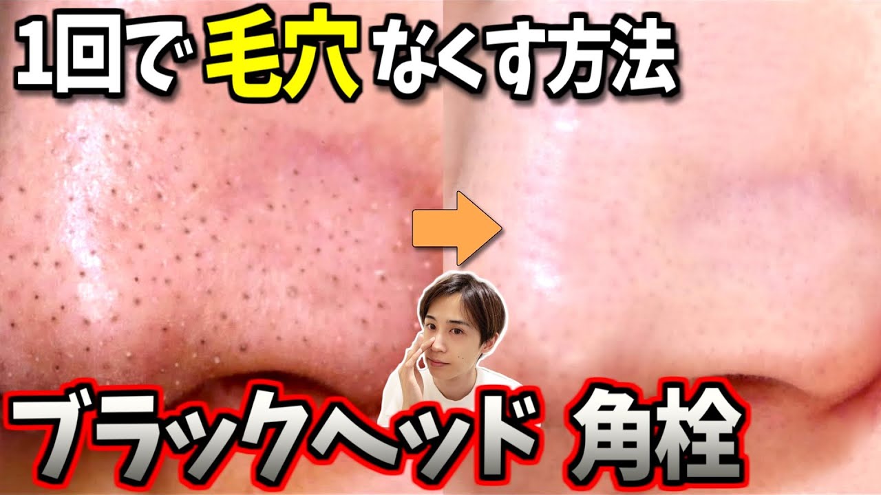 【毛穴なくす方法】毛穴ブラックヘッド除去とおススメのスキンケア！ Black head remover
