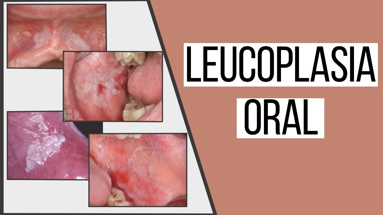 Leucoplasia oral | Odontologia Con Cri