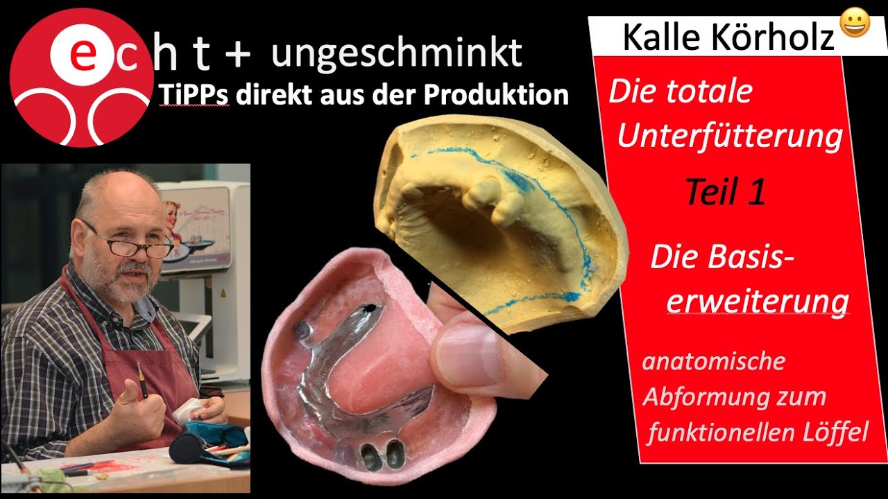 Unterfütterung/Basiserweiterung -1. Teil - mit Teleskop-Prothese