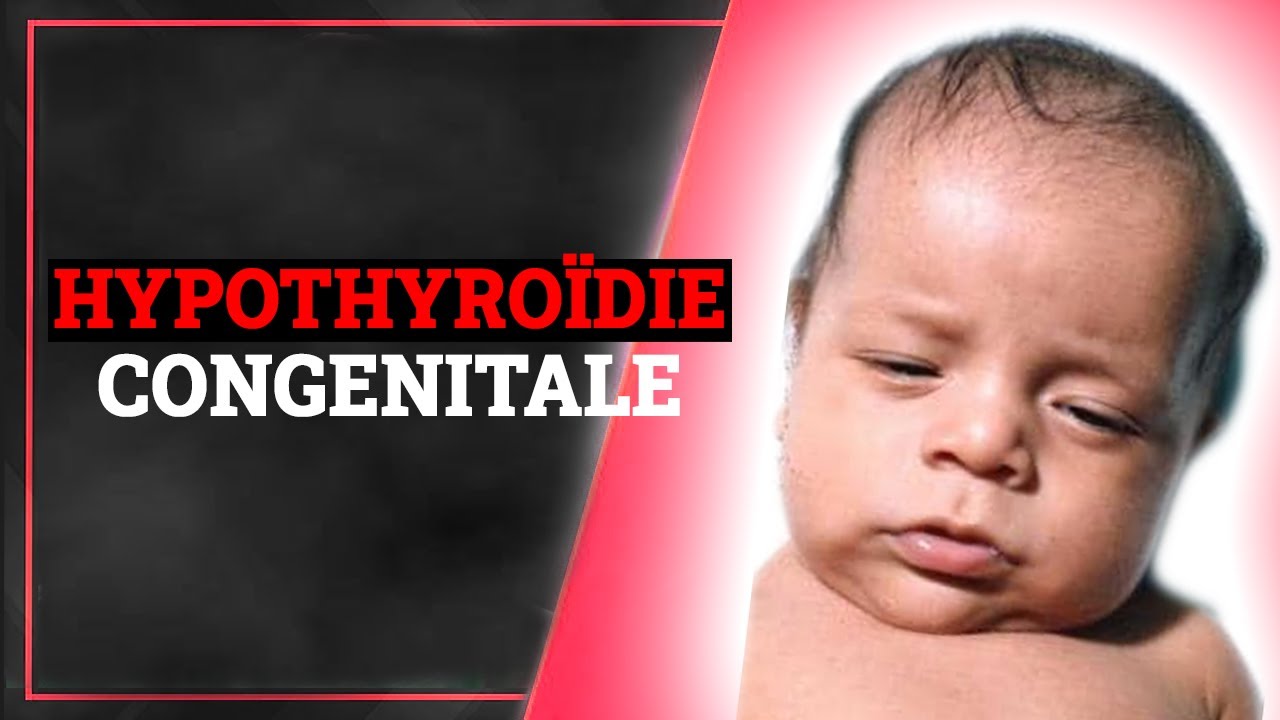 Hypothyroïdie Congénitale: Symptômes, Causes, Traitement | Endocrinologie Medicale
