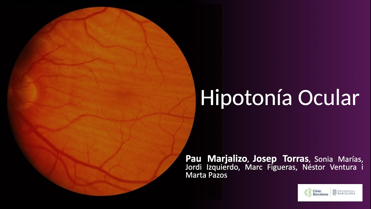 Hipotonía Ocular - Maculopatía Hipotónica: Fisiopatología, Hallazgos Clínicos y Tratamiento.