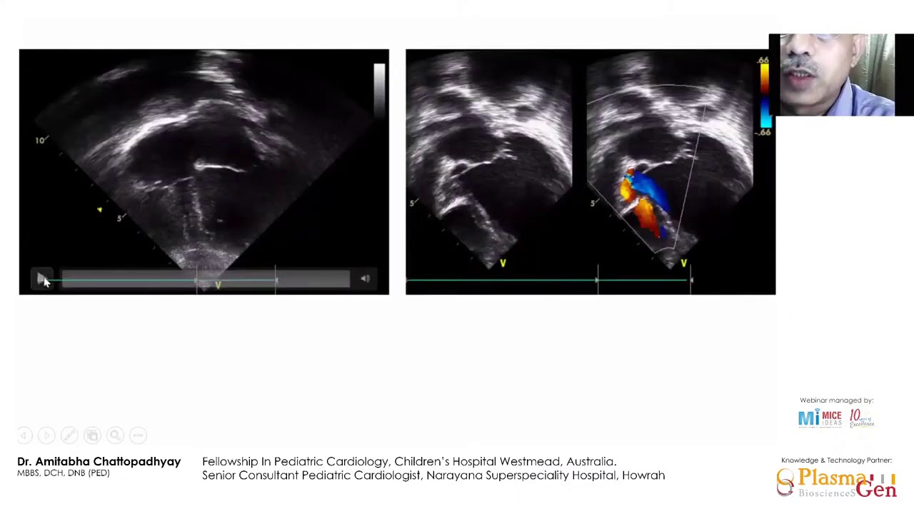 Part 3- A Cardiologist's role in Kawasaki Disease - Dr Amitabha Chattapadhyay, Australia