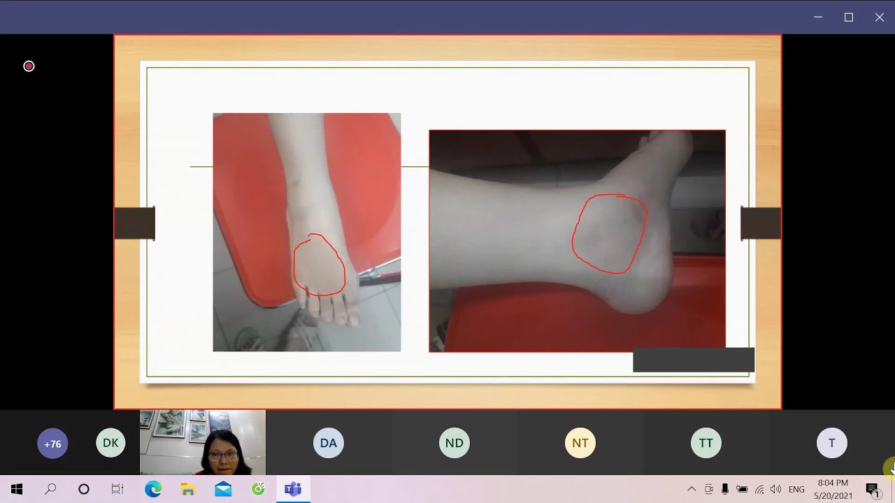 Chẩn đoán viêm cột sống dính khớp: ứng dụng tiêu chuẩn hình ảnh học | ThS. BS. Đinh Thị Minh Hảo