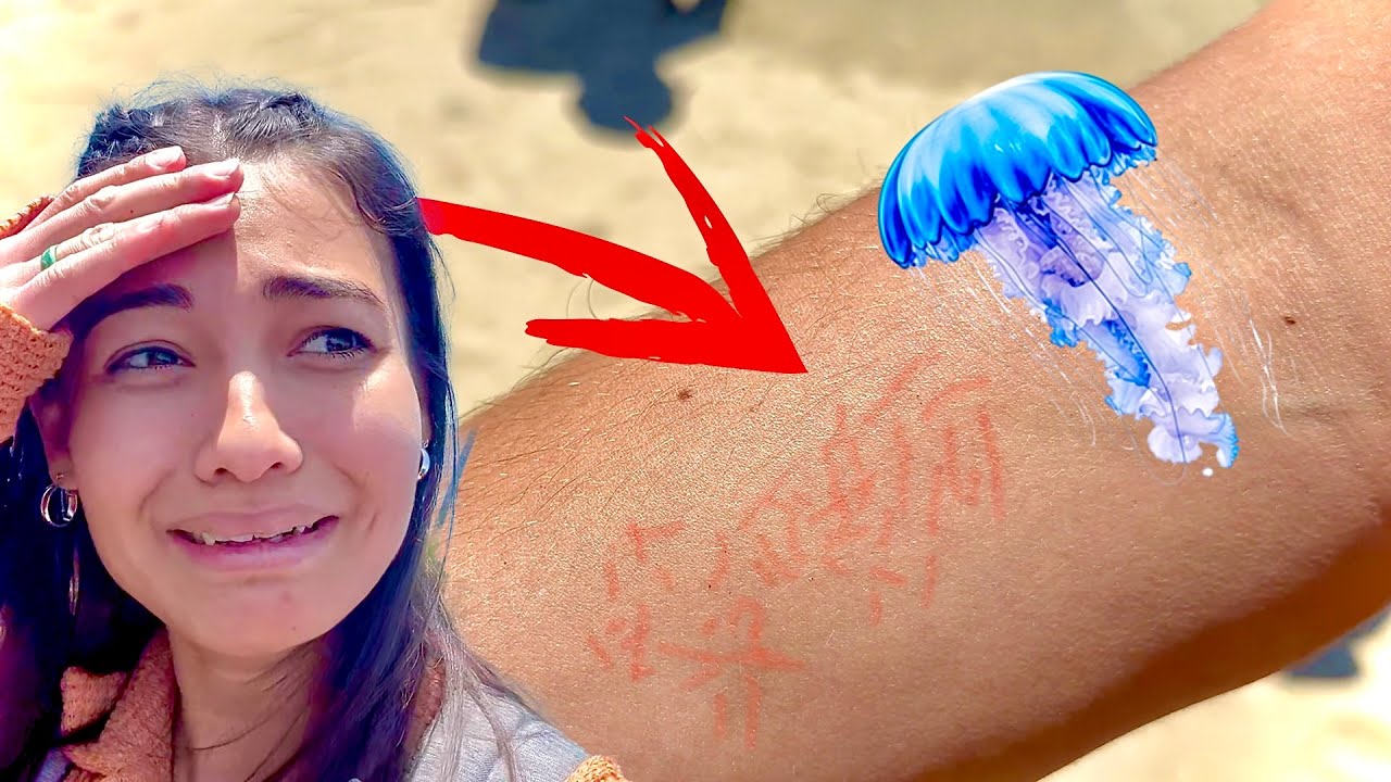 Stung By A JELLYFISH!!