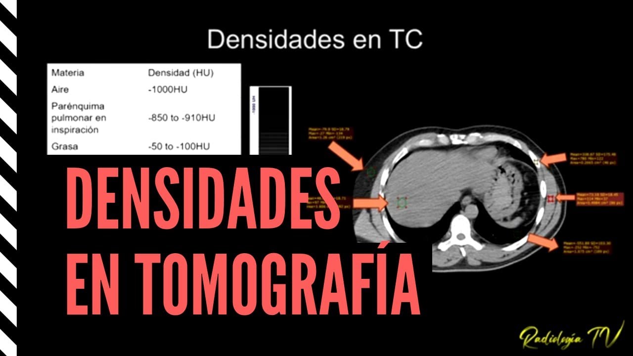 Densidades en tomografía
