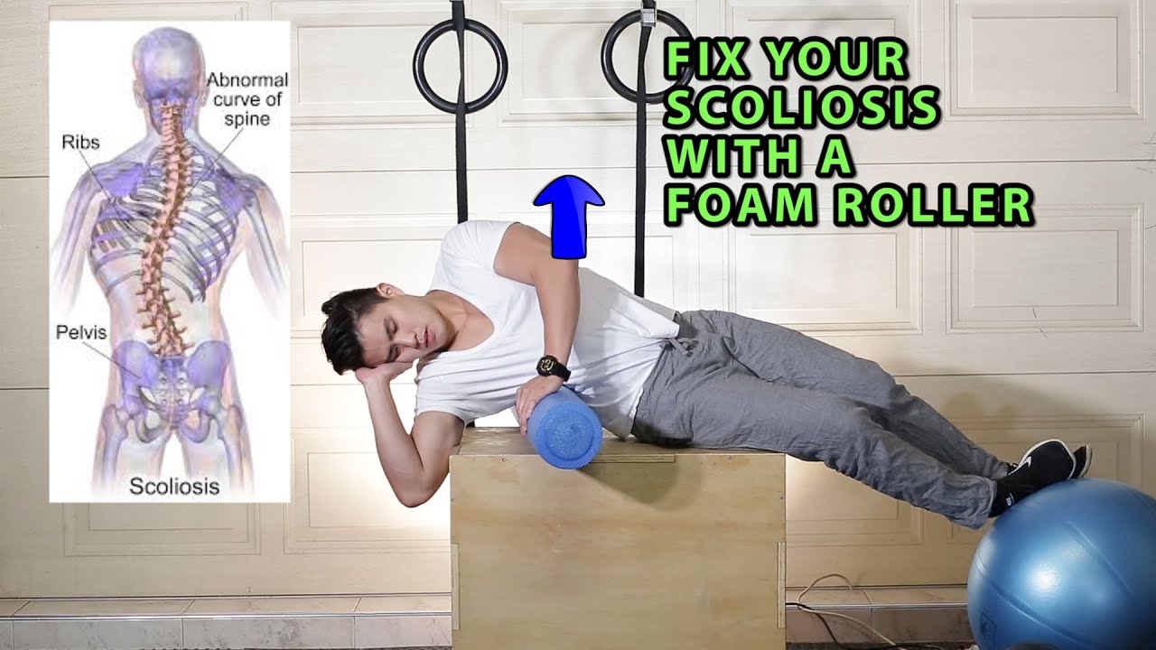 Fix Your Scoliosis with a Foam Roller (Scroth's Method)