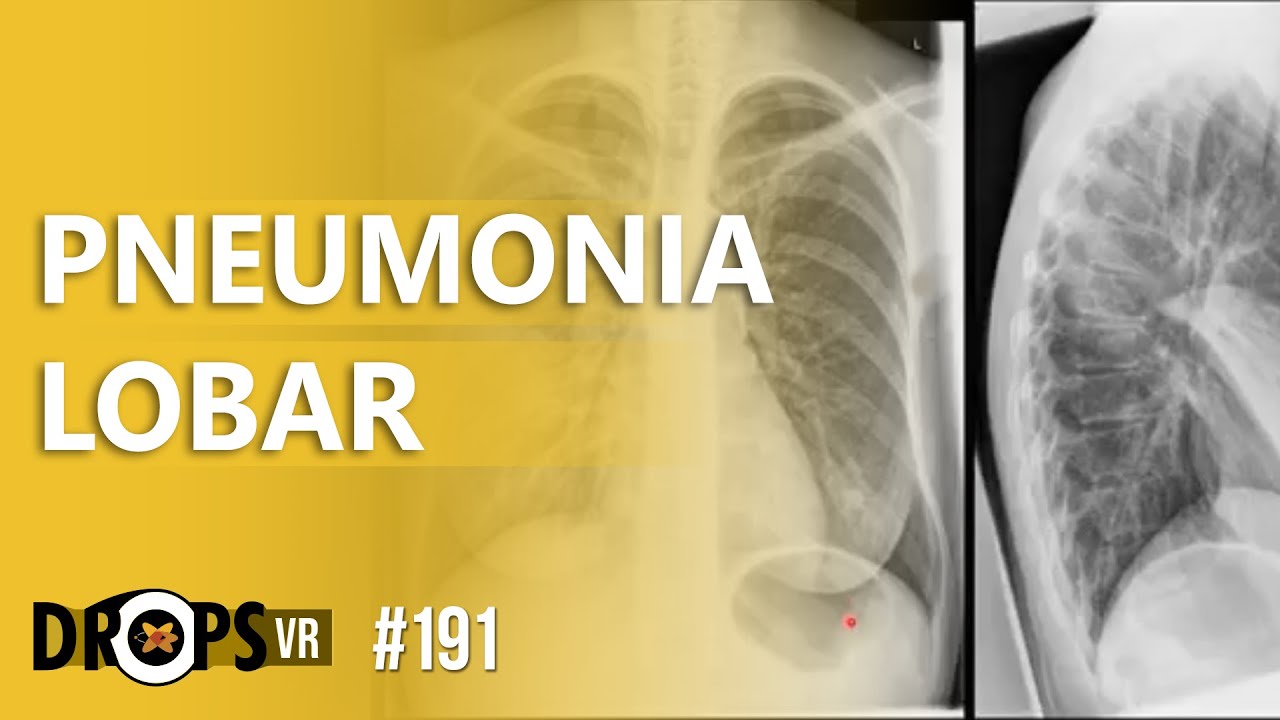 PNEUMONIA LOBAR NO RAIO-X