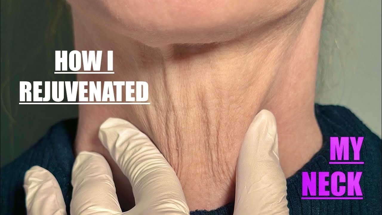 It’s completely CHANGED my NECK | TURKEY NECK, SAGGING NECK, WRINKLES ON THE NECK