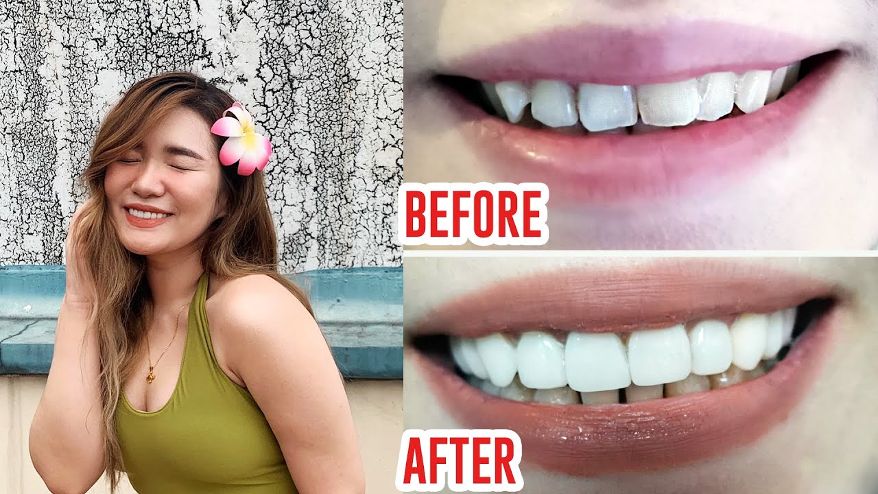 PAANO GUMANDA AGAD ANG IPIN KO!? (VENEERS Experience) | Toni Sia