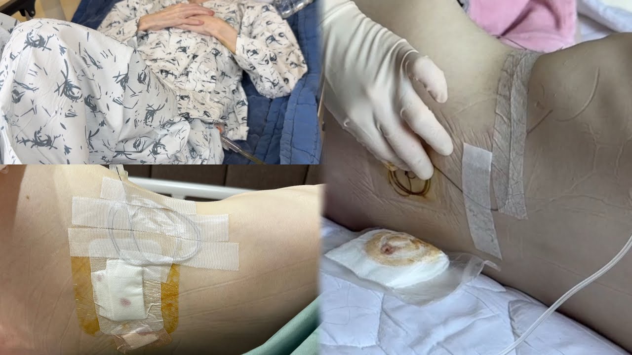 암환자 브이로그 | 시술 실패,,피랑 액체가 척추 쪽에서 계속 새고 있어요😞 | 뼈전이 | 20대 암환자 | 4기 암환자 | 희귀암 | 투병 브이로그 