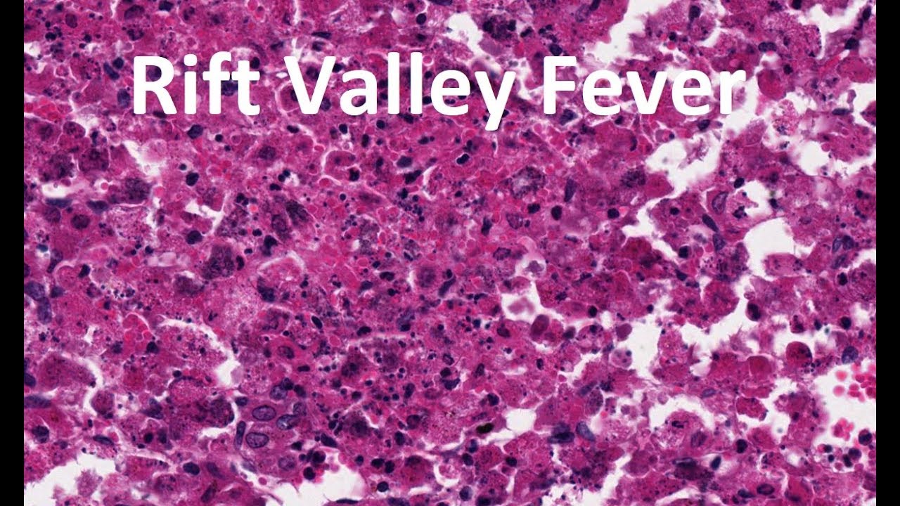 Rift Valley Fever