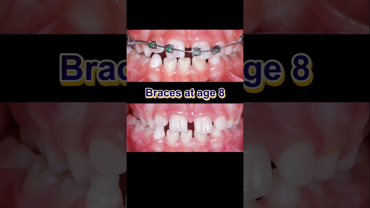 Braces at age 8. Fix gapped teeth #braces #dentist #orthodontist