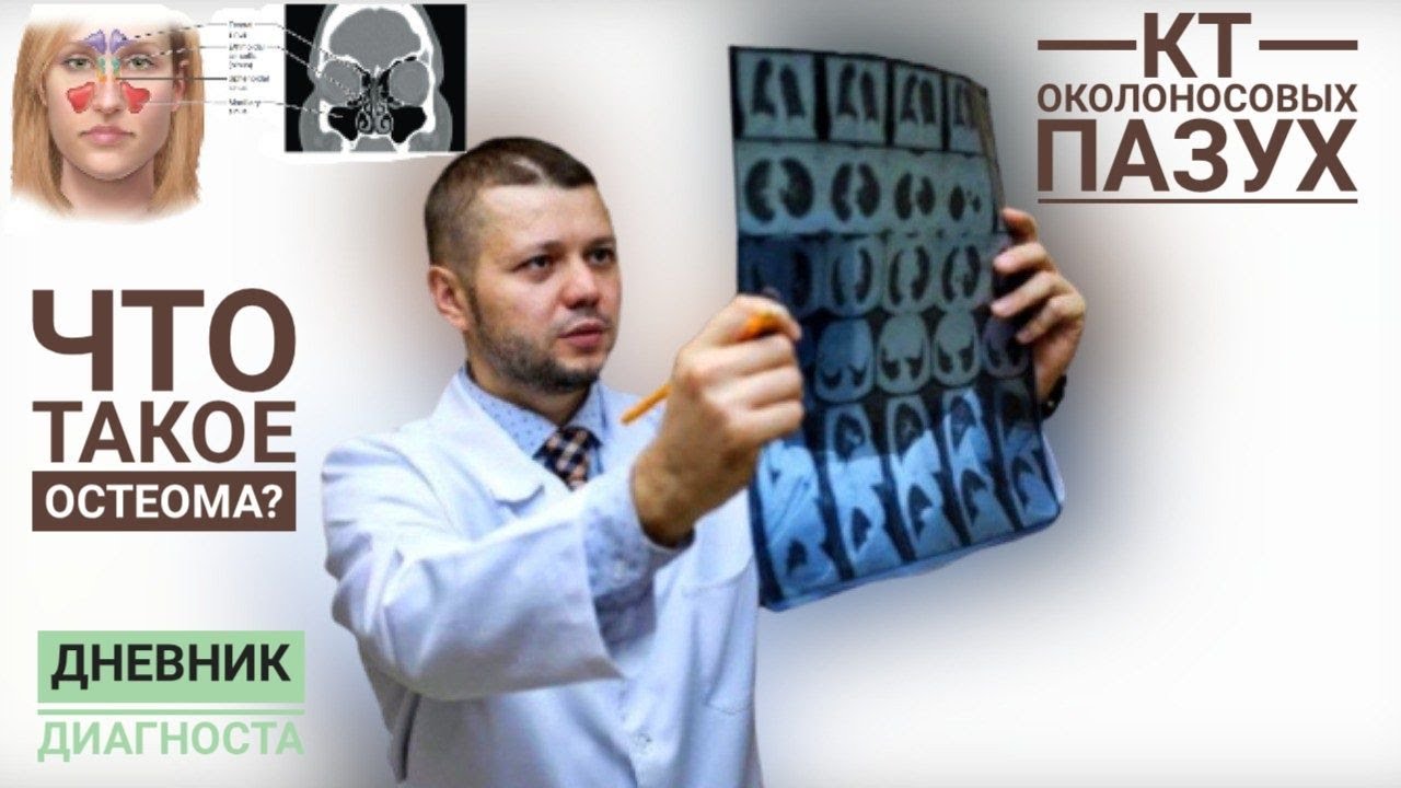 КТ околоносовых пазух. Что такое остеома?