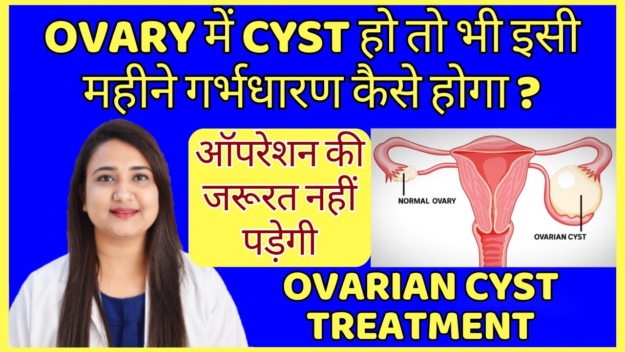 OVARY में CYST हो तो भी इसी महीने गर्भधारण कैसे होगा ? OVARIAN CYST BEST TREATMENT