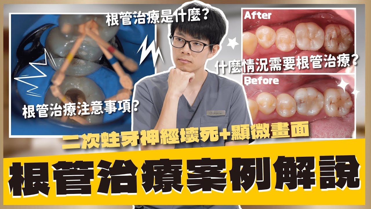 【蛀牙 #11】根管治療的步驟有哪些？根管治療還需要注意這些情況？就讓小許醫師利用這些根管治療的案例帶大家深入了解！｜【祐民牙醫－隱適美旗艦店】鑽石級楊大為醫師 #根管治療 #祐民牙醫 #抽神經