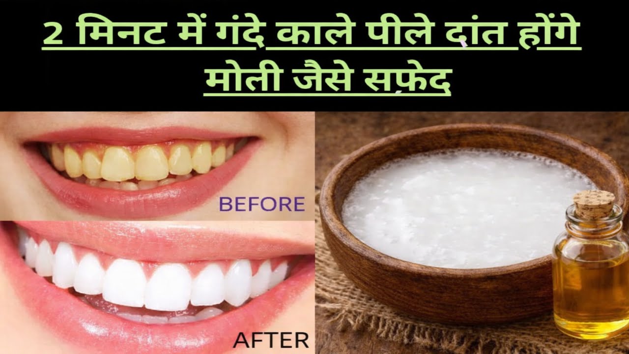पीले दांतों को सफेद कैसे करें? | How to Whiten Teeth at Home? | Home Remedies for White Teeth