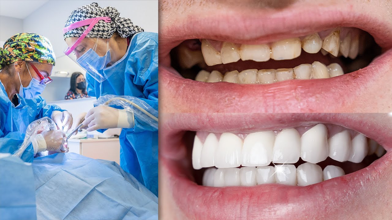 Hollywood Smile w Turcji | Implanty + Korony + Licówki